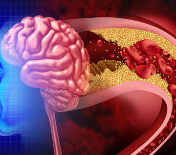Закупорку периваскулярных пространств связали с развитием болезни Альцгеймера
