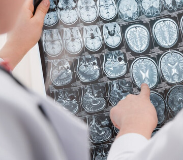 Ученые обнаружили новое неврологическое заболевание