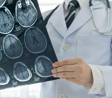 Обновлены критерии для диагностики рассеянного склероза