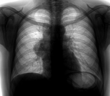 В России впервые удалили опухоль средостения с прорастанием в сердце и легкое