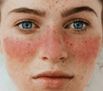 Ученые обнаружили связь между волчанкой и вирусом Эпштейна-Барр